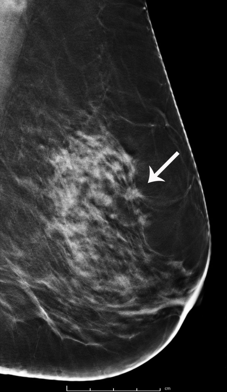 case study of a patient with breast cancer